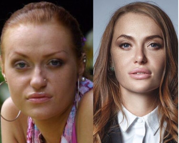 Слава Камінська до та після пластики