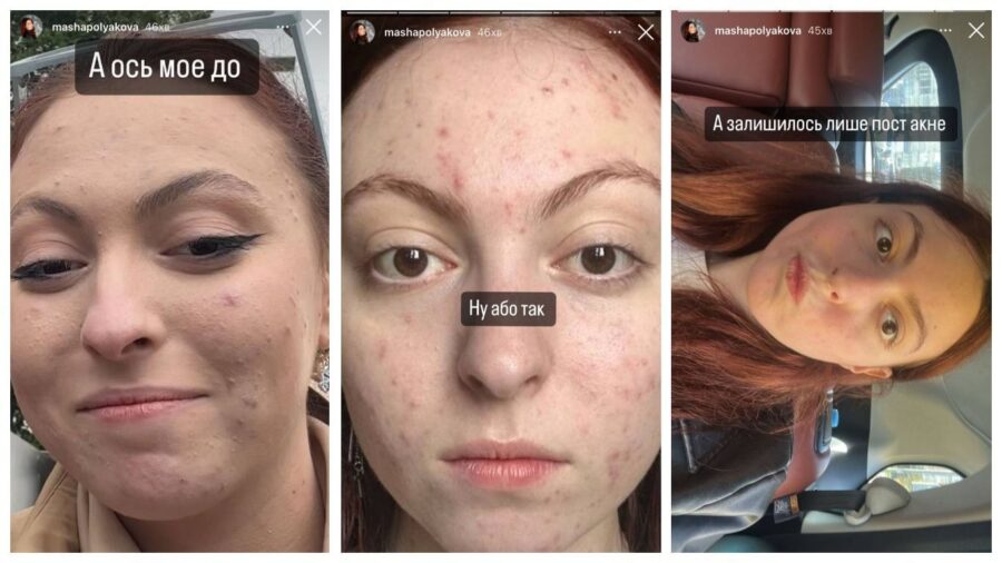 Маша Полякова розповіла, як боролась з акне та показала результати після