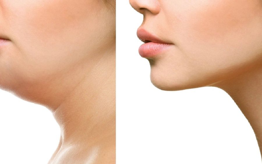 Як прибрати друге підборіддя