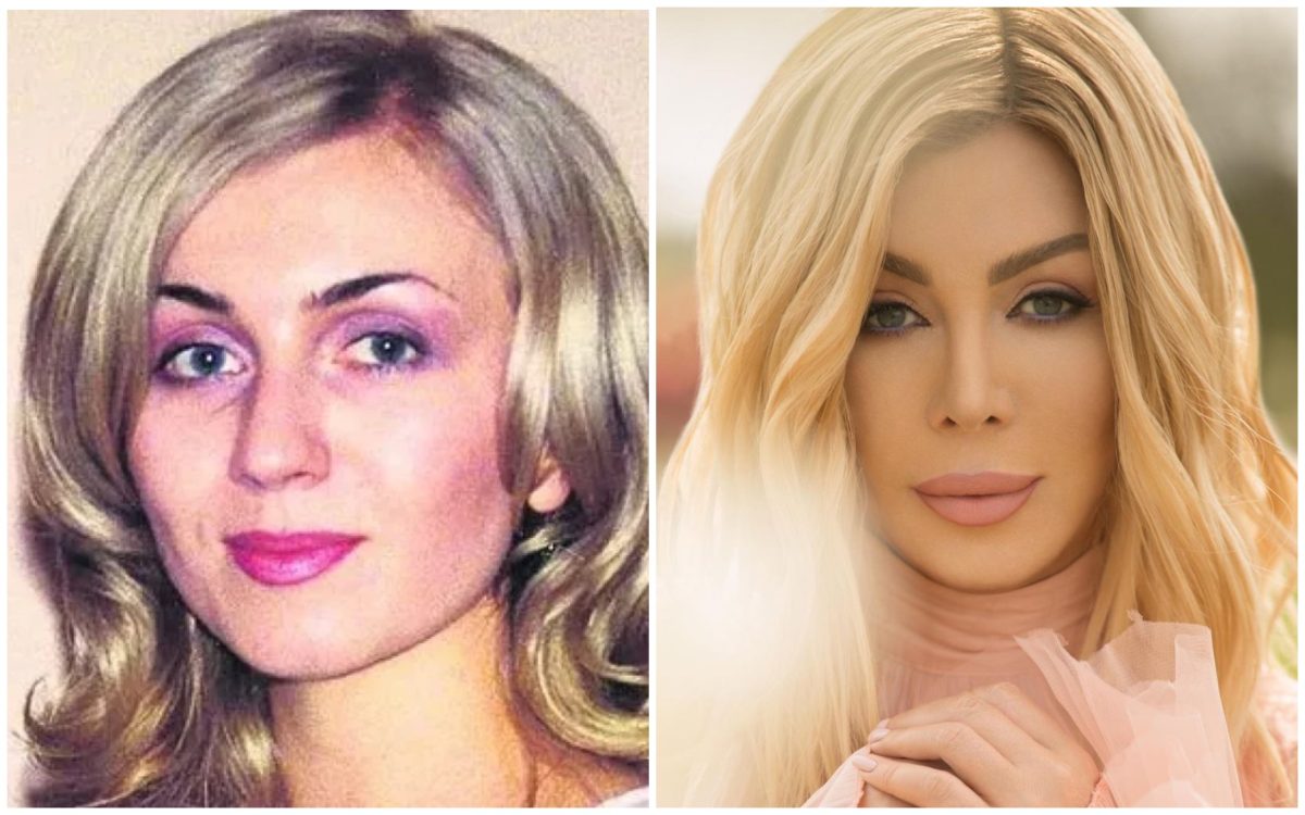 Ірина Білик розповіла про всі свої пластичні операції