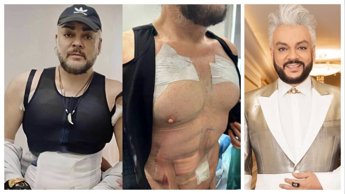 Філіп Кіркоров зробив собі штучні кубикипресу 