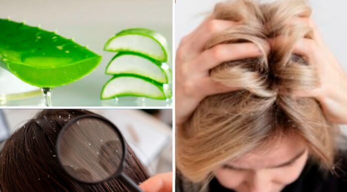 По 5 крапель під час миття голови – і лупа зникає назавжди: шкіра голови здорова, а волосся як блищить Як позбутися лупи за допомогою соку алое