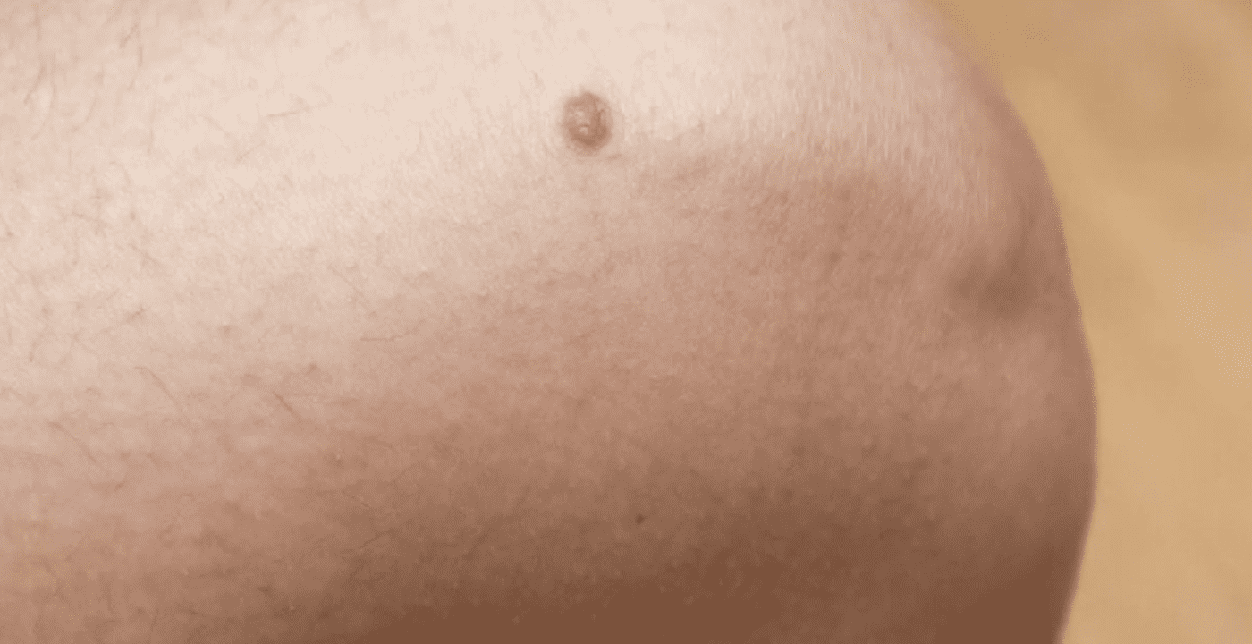 Коли родимку варто показати спеціалісту. Фото: YouTube Телеканал Конкурент Україна