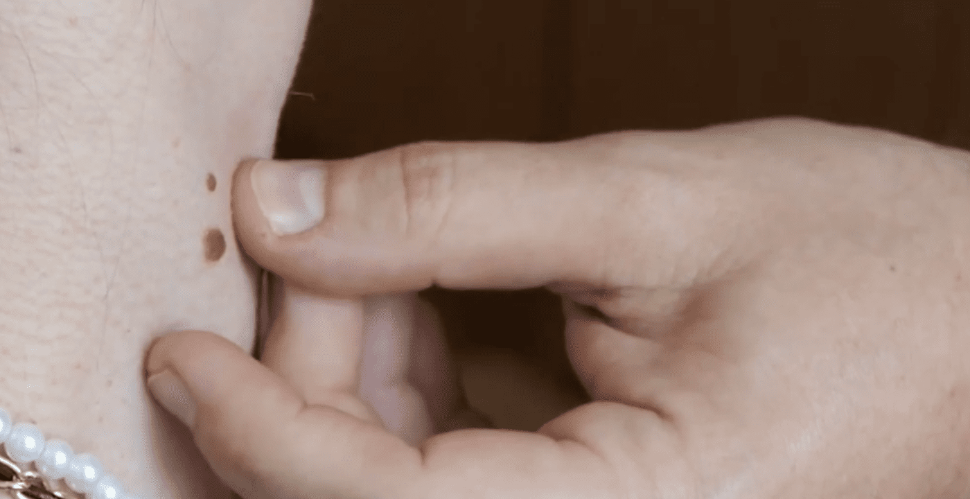 Коли родимку варто показати спеціалісту. Фото: YouTube Телеканал Конкурент Україна