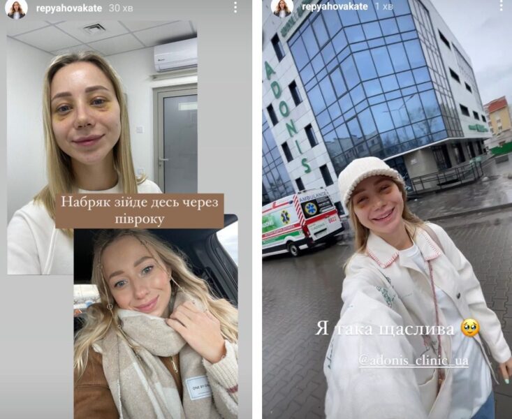 Катя Репяхова вперше показала ніс після пластичної операції