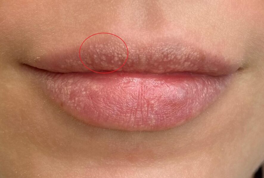 Гранули Фордайса можна перекрити за допомогою перманентного макіяжу губ