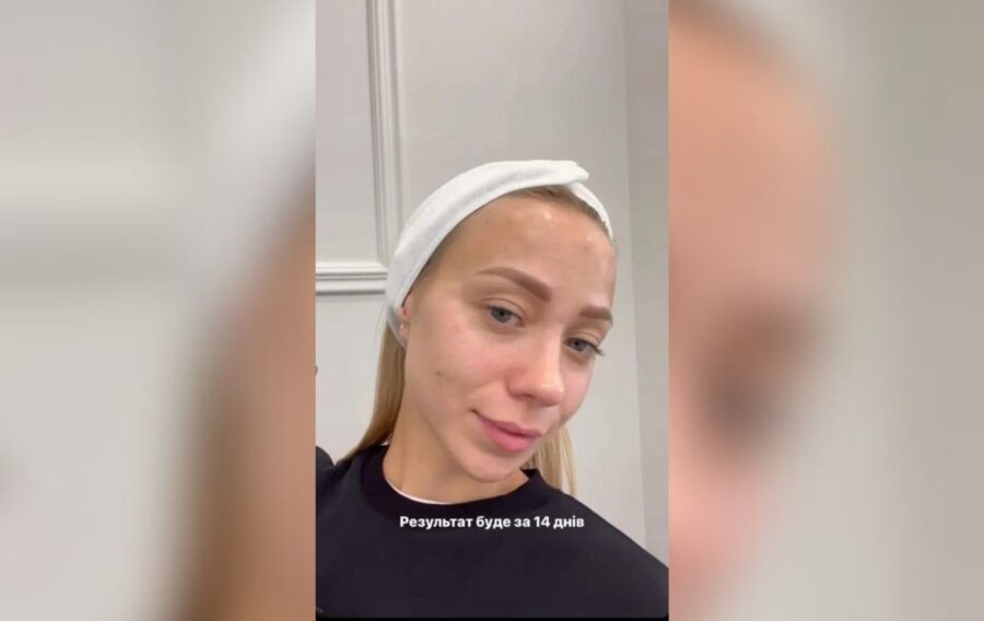 Катерина Репяхова повідомила, що зробила укол ботоксу у косметолога