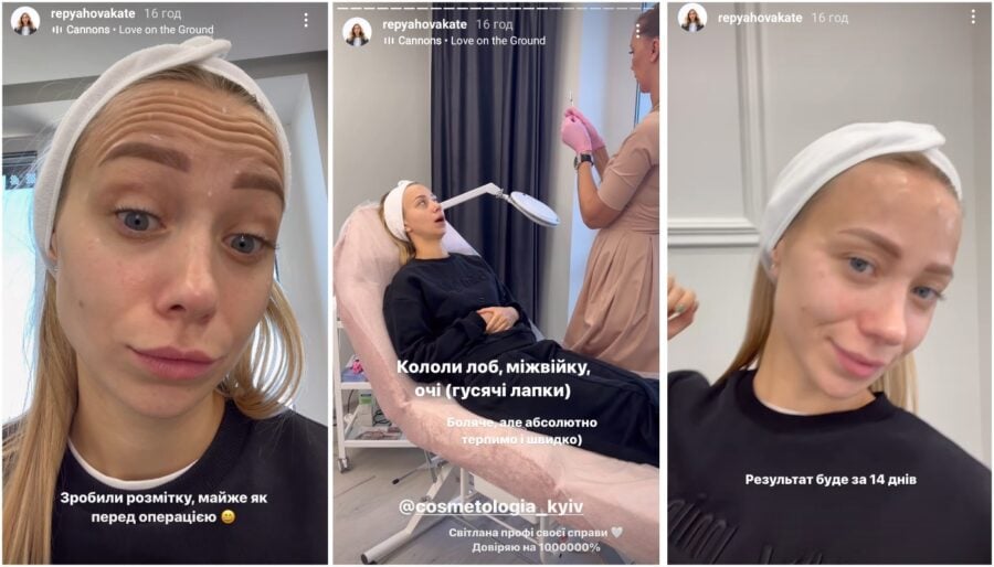 Дружина Павліка Катя Репяхова після пластики носа та збільшення губ наважилася на зміни в обличчі