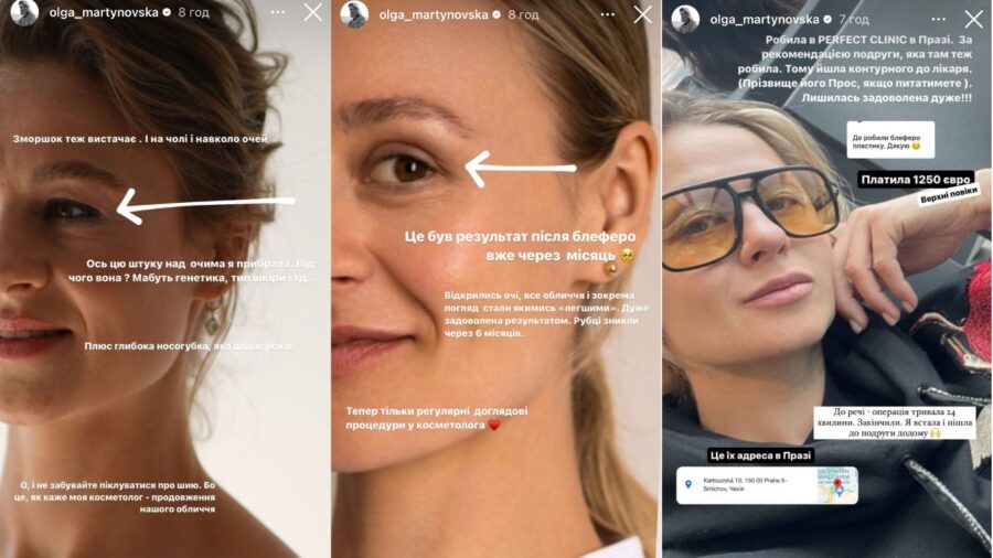 Ольга Мартиновська показала результат пластичної операції